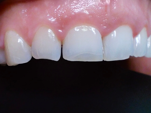 antes-tratamiento-odontologico Rehabilitación oral por desgaste severo en paciente joven antes del tratamiento