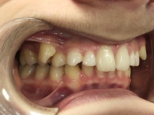 antes-tratamiento-odontologico