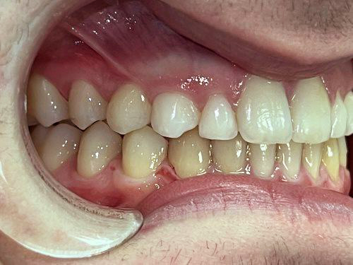 oclusion-despues-tratamiento-odontologico