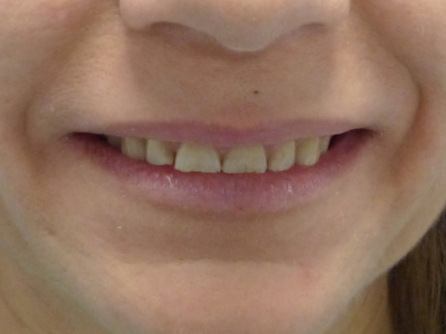 antes-tratamiento-odontologico La paciente quería un tto de carillas porque sus dientes estaban muy desgastados, después de realizarle un diseño de sonrisa, se le pusieron carillas en la arcada superior y obturaciones en la inferior para subir la dimensión vertical y así obtener una mejor oclusión.